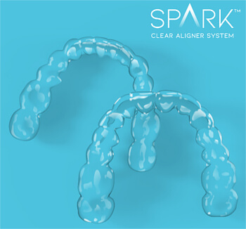 spark aligners